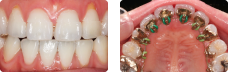 Lingual Braces + Retainer